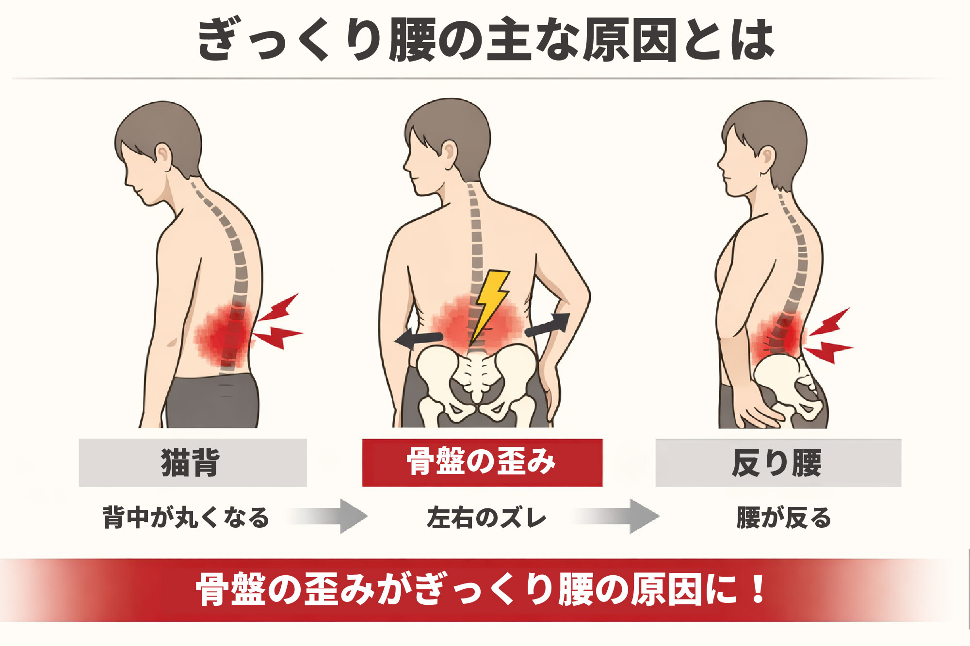 ぎっくり腰の原因となる骨盤の歪み|大津市堅田 整骨院