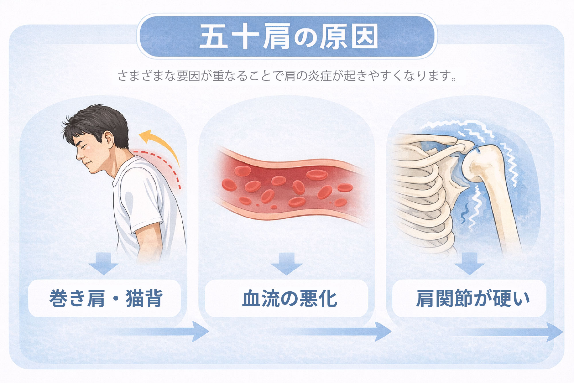 五十肩の原因イメージ|大津市堅田